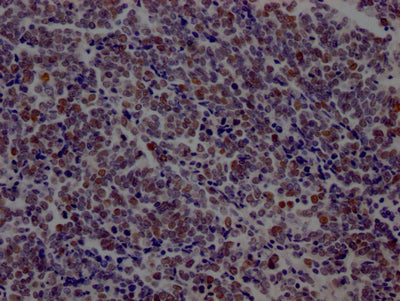 IHC image of RAC07294 diluted at 1:100 and staining in paraffin-embedded human lung cancer performed on a Leica BondTM system. After dewaxing and hydration, antigen retrieval was mediated by high pressure in a citrate buffer (pH 6.0). Section was blocked with 10% normal goat serum 30min at RT. Then primary antibody (1% BSA) was incubated at 4? overnight. The primary is detected by a Goat anti-rabbit IgG polymer labeled by HRP and visualized using 0.05% DAB.