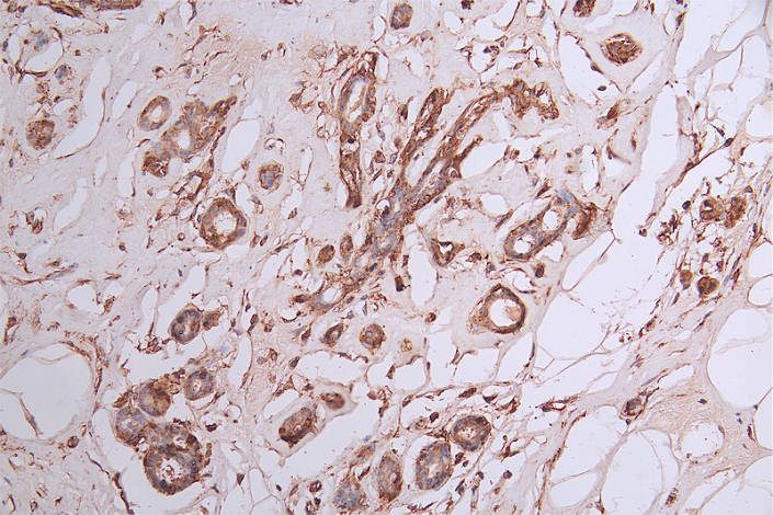 IHC image of RAC07298 diluted at 1:50 and staining in paraffin-embedded human breast cancer performed on a Leica BondTM system. After dewaxing and hydration, antigen retrieval was mediated by high pressure in a citrate buffer (pH 6.0). Section was blocked with 10% normal goat serum 30min at RT. Then primary antibody (1% BSA) was incubated at 4Â°C overnight. The primary is detected by a Goat anti-rabbit polymer IgG labeled by HRP and visualized using 0.35% DAB.