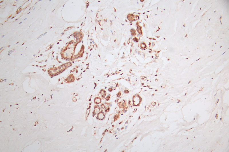 IHC image of RAC07300 diluted at 1:50 and staining in paraffin-embedded human breast cancer performed on a Leica BondTM system. After dewaxing and hydration, antigen retrieval was mediated by high pressure in a citrate buffer (pH 6.0). Section was blocked with 10% normal goat serum 30min at RT. Then primary antibody (1% BSA) was incubated at 4Â°C overnight. The primary is detected by a Goat anti-rabbit polymer IgG labeled by HRP and visualized using 0.58% DAB.