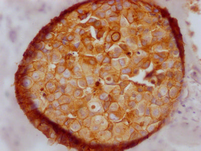 IHC image of RAC07302 diluted at 1:100 and staining in paraffin-embedded human breast cancer performed on a Leica BondTM system. After dewaxing and hydration, antigen retrieval was mediated by high pressure in a citrate buffer (pH 6.0). Section was blocked with 10% normal goat serum 30min at RT. Then primary antibody (1% BSA) was incubated at 4? overnight. The primary is detected by a Goat anti-rabbit IgG polymer labeled by HRP and visualized using 0.05% DAB.