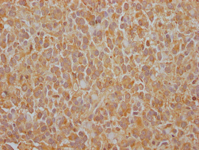 IHC image of RAC07308 diluted at 1:100 and staining in paraffin-embedded human glioma cancer performed on a Leica BondTM system. After dewaxing and hydration, antigen retrieval was mediated by high pressure in a citrate buffer (pH 6.0). Section was blocked with 10% normal goat serum 30min at RT. Then primary antibody (1% BSA) was incubated at 4? overnight. The primary is detected by a Goat anti-rabbit IgG polymer labeled by HRP and visualized using 0.05% DAB.