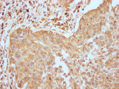 IHC image of RAC07308 diluted at 1:100 and staining in paraffin-embedded human cervical cancer performed on a Leica BondTM system. After dewaxing and hydration, antigen retrieval was mediated by high pressure in a citrate buffer (pH 6.0). Section was blocked with 10% normal goat serum 30min at RT. Then primary antibody (1% BSA) was incubated at 4? overnight. The primary is detected by a Goat anti-rabbit IgG polymer labeled by HRP and visualized using 0.05% DAB.