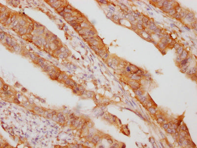 IHC image of RAC07312 diluted at 1:100 and staining in paraffin-embedded human colon cancer performed on a Leica BondTM system. After dewaxing and hydration, antigen retrieval was mediated by high pressure in a citrate buffer (pH 6.0). Section was blocked with 10% normal goat serum 30min at RT. Then primary antibody (1% BSA) was incubated at 4? overnight. The primary is detected by a Goat anti-rabbit IgG polymer labeled by HRP and visualized using 0.05% DAB.