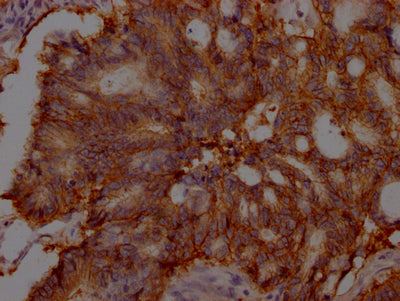 IHC image of RAC07315 diluted at 1:100 and staining in paraffin-embedded human colon cancer performed on a Leica BondTM system. After dewaxing and hydration, antigen retrieval was mediated by high pressure in a citrate buffer (pH 6.0). Section was blocked with 10% normal goat serum 30min at RT. Then primary antibody (1% BSA) was incubated at 4? overnight. The primary is detected by a Goat anti-rabbit IgG polymer labeled by HRP and visualized using 0.05% DAB.