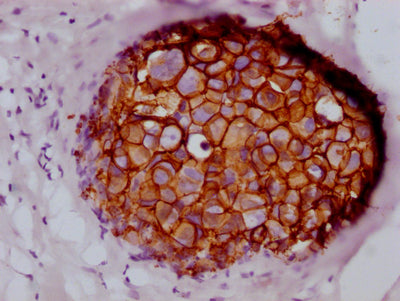 IHC image of RAC07319 diluted at 1:100 and staining in paraffin-embedded human breast cancer performed on a Leica BondTM system. After dewaxing and hydration, antigen retrieval was mediated by high pressure in a citrate buffer (pH 6.0). Section was blocked with 10% normal goat serum 30min at RT. Then primary antibody (1% BSA) was incubated at 4? overnight. The primary is detected by a Goat anti-rabbit IgG polymer labeled by HRP and visualized using 0.05% DAB.