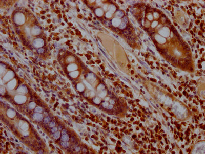 IHC image of RAC07321 diluted at 1:100 and staining in paraffin-embedded human colon cancer performed on a Leica BondTM system. After dewaxing and hydration, antigen retrieval was mediated by high pressure in a citrate buffer (pH 6.0). Section was blocked with 10% normal goat serum 30min at RT. Then primary antibody (1% BSA) was incubated at 4? overnight. The primary is detected by a Goat anti-rabbit IgG polymer labeled by HRP and visualized using 0.05% DAB.