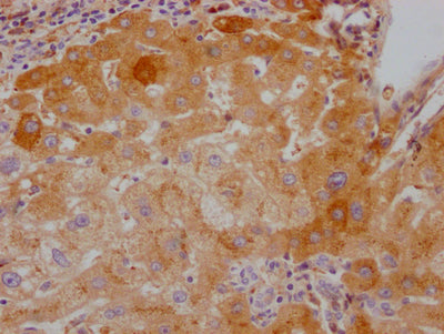 IHC image of RAC07327 diluted at 1:100 and staining in paraffin-embedded human liver cancer performed on a Leica BondTM system. After dewaxing and hydration, antigen retrieval was mediated by high pressure in a citrate buffer (pH 6.0). Section was blocked with 10% normal goat serum 30min at RT. Then primary antibody (1% BSA) was incubated at 4? overnight. The primary is detected by a Goat anti-rabbit IgG polymer labeled by HRP and visualized using 0.05% DAB.