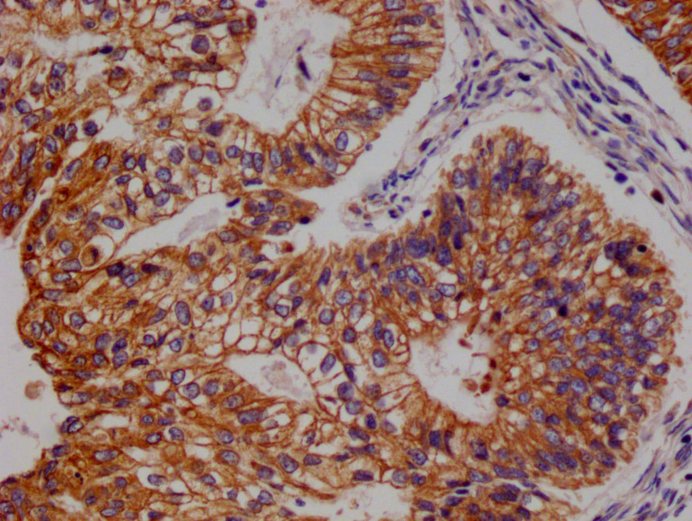 IHC image of RAC07328 diluted at 1:100 and staining in paraffin-embedded human endometrial cancer performed on a Leica BondTM system. After dewaxing and hydration, antigen retrieval was mediated by high pressure in a citrate buffer (pH 6.0). Section was blocked with 10% normal goat serum 30min at RT. Then primary antibody (1% BSA) was incubated at 4Â°C overnight. The primary is detected by a Goat anti-rabbit polymer IgG labeled by HRP and visualized using 0.05% DAB.