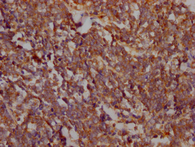 IHC image of RAC07329 diluted at 1:100 and staining in paraffin-embedded human lung cancer performed on a Leica BondTM system. After dewaxing and hydration, antigen retrieval was mediated by high pressure in a citrate buffer (pH 6.0). Section was blocked with 10% normal goat serum 30min at RT. Then primary antibody (1% BSA) was incubated at 4? overnight. The primary is detected by a Goat anti-rabbit IgG polymer labeled by HRP and visualized using 0.05% DAB.