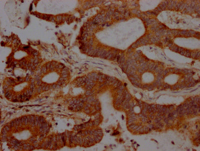 IHC image of RAC07330 diluted at 1:100 and staining in paraffin-embedded human colon cancer performed on a Leica BondTM system. After dewaxing and hydration, antigen retrieval was mediated by high pressure in a citrate buffer (pH 6.0). Section was blocked with 10% normal goat serum 30min at RT. Then primary antibody (1% BSA) was incubated at 4? overnight. The primary is detected by a Goat anti-rabbit IgG polymer labeled by HRP and visualized using 0.05% DAB.
