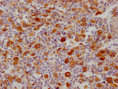 IHC image of RAC07333 diluted at 1:100 and staining in paraffin-embedded human lung cancer performed on a Leica BondTM system. After dewaxing and hydration, antigen retrieval was mediated by high pressure in a citrate buffer (pH 6.0). Section was blocked with 10% normal goat serum 30min at RT. Then primary antibody (1% BSA) was incubated at 4? overnight. The primary is detected by a Goat anti-rabbit IgG polymer labeled by HRP and visualized using 0.05% DAB.