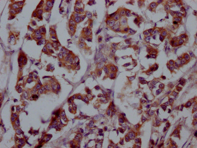 IHC image of RAC07340 diluted at 1:100 and staining in paraffin-embedded human breast cancer performed on a Leica BondTM system. After dewaxing and hydration, antigen retrieval was mediated by high pressure in a citrate buffer (pH 6.0). Section was blocked with 10% normal goat serum 30min at RT. Then primary antibody (1% BSA) was incubated at 4? overnight. The primary is detected by a Goat anti-rabbit IgG polymer labeled by HRP and visualized using 0.05% DAB.