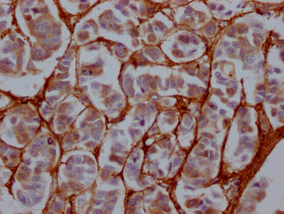 IHC image of RAC07341 diluted at 1:100 and staining in paraffin-embedded human breast cancer performed on a Leica BondTM system. After dewaxing and hydration, antigen retrieval was mediated by high pressure in a citrate buffer (pH 6.0). Section was blocked with 10% normal goat serum 30min at RT. Then primary antibody (1% BSA) was incubated at 4? overnight. The primary is detected by a Goat anti-rabbit IgG polymer labeled by HRP and visualized using 0.05% DAB.