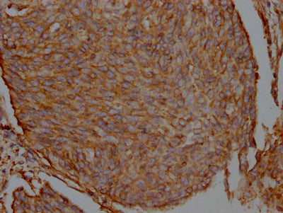 IHC image of RAC07342 diluted at 1:100 and staining in paraffin-embedded human cervical cancer performed on a Leica BondTM system. After dewaxing and hydration, antigen retrieval was mediated by high pressure in a citrate buffer (pH 6.0). Section was blocked with 10% normal goat serum 30min at RT. Then primary antibody (1% BSA) was incubated at 4? overnight. The primary is detected by a Goat anti-rabbit IgG polymer labeled by HRP and visualized using 0.05% DAB.