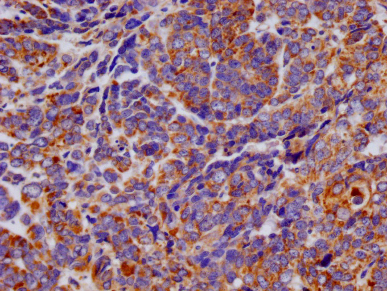 IHC image of RAC07343 diluted at 1:100 and staining in paraffin-embedded human ovarian cancer performed on a Leica BondTM system. After dewaxing and hydration, antigen retrieval was mediated by high pressure in a citrate buffer (pH 6.0). Section was blocked with 10% normal goat serum 30min at RT. Then primary antibody (1% BSA) was incubated at 4Â°C overnight. The primary is detected by a Goat anti-rabbit polymer IgG labeled by HRP and visualized using 0.05% DAB.