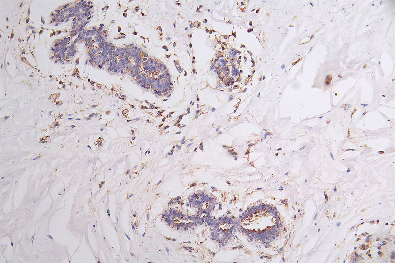 IHC image of RAC07344 diluted at 1:100 and staining in paraffin-embedded human breast cancer performed on a Leica BondTM system. After dewaxing and hydration, antigen retrieval was mediated by high pressure in a citrate buffer (pH 6.0). Section was blocked with 10% normal goat serum 30min at RT. Then primary antibody (1% BSA) was incubated at 4Â°C overnight. The primary is detected by a Goat anti-rabbit polymer IgG labeled by HRP and visualized using 0.21% DAB.