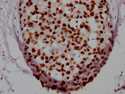 IHC image of RAC07347 diluted at 1:100 and staining in paraffin-embedded human breast cancer performed on a Leica BondTM system. After dewaxing and hydration, antigen retrieval was mediated by high pressure in a citrate buffer (pH 6.0). Section was blocked with 10% normal goat serum 30min at RT. Then primary antibody (1% BSA) was incubated at 4? overnight. The primary is detected by a Goat anti-rabbit IgG polymer labeled by HRP and visualized using 0.05% DAB.