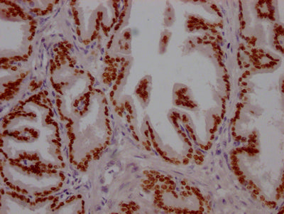 IHC image of RAC07347 diluted at 1:100 and staining in paraffin-embedded human prostate tissue performed on a Leica BondTM system. After dewaxing and hydration, antigen retrieval was mediated by high pressure in a citrate buffer (pH 6.0). Section was blocked with 10% normal goat serum 30min at RT. Then primary antibody (1% BSA) was incubated at 4? overnight. The primary is detected by a Goat anti-rabbit IgG polymer labeled by HRP and visualized using 0.05% DAB.