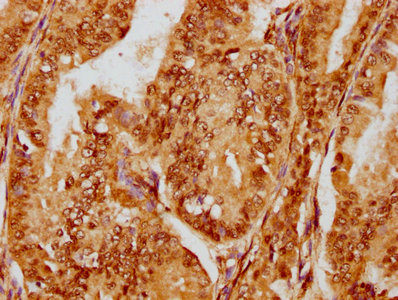 IHC image of RAC07348 diluted at 1:180 and staining in paraffin-embedded human endometrial cancer performed on a Leica BondTM system. After dewaxing and hydration, antigen retrieval was mediated by high pressure in a citrate buffer (pH 6.0). Section was blocked with 10% normal goat serum 30min at RT. Then primary antibody (1% BSA) was incubated at 4? overnight. The primary is detected by a biotinylated secondary antibody and visualized using an HRP conjugated SP system.