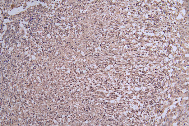 IHC image of RAC07352 diluted at 1:50 and staining in paraffin-embedded human glioma cancer performed on a Leica BondTM system. After dewaxing and hydration, antigen retrieval was mediated by high pressure in a citrate buffer (pH 6.0). Section was blocked with 10% normal goat serum 30min at RT. Then primary antibody (1% BSA) was incubated at 4Â°C overnight. The primary is detected by a Goat anti-rabbit polymer IgG labeled by HRP and visualized using 0.29% DAB.