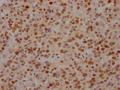 IHC image of RAC07353 diluted at 1:100 and staining in paraffin-embedded human glioma cancer performed on a Leica BondTM system. After dewaxing and hydration, antigen retrieval was mediated by high pressure in a citrate buffer (pH 6.0). Section was blocked with 10% normal goat serum 30min at RT. Then primary antibody (1% BSA) was incubated at 4? overnight. The primary is detected by a Goat anti-rabbit IgG polymer labeled by HRP and visualized using 0.05% DAB.