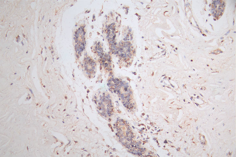 IHC image of RAC07356 diluted at 1:50 and staining in paraffin-embedded human breast cancer performed on a Leica BondTM system. After dewaxing and hydration, antigen retrieval was mediated by high pressure in a citrate buffer (pH 6.0). Section was blocked with 10% normal goat serum 30min at RT. Then primary antibody (1% BSA) was incubated at 4Â°C overnight. The primary is detected by a Goat anti-rabbit polymer IgG labeled by HRP and visualized using 0.15% DAB.