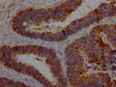 IHC image of RAC07358 diluted at 1:100 and staining in paraffin-embedded human ovarian cancer performed on a Leica BondTM system. After dewaxing and hydration, antigen retrieval was mediated by high pressure in a citrate buffer (pH 6.0). Section was blocked with 10% normal goat serum 30min at RT. Then primary antibody (1% BSA) was incubated at 4? overnight. The primary is detected by a Goat anti-rabbit IgG polymer labeled by HRP and visualized using 0.05% DAB.