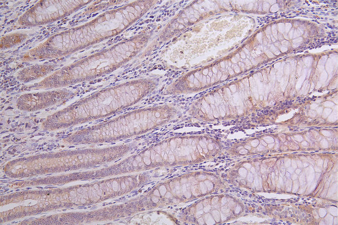 IHC image of RAC07364 diluted at 1:100 and staining in paraffin-embedded human rectal cancer performed on a Leica BondTM system. After dewaxing and hydration, antigen retrieval was mediated by high pressure in a citrate buffer (pH 6.0). Section was blocked with 10% normal goat serum 30min at RT. Then primary antibody (1% BSA) was incubated at 4Â°C overnight. The primary is detected by a Goat anti-rabbit polymer IgG labeled by HRP and visualized using 0.14% DAB.