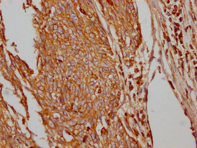 IHC image of RAC07365 diluted at 1:100 and staining in paraffin-embedded human cervical cancer performed on a Leica BondTM system. After dewaxing and hydration, antigen retrieval was mediated by high pressure in a citrate buffer (pH 6.0). Section was blocked with 10% normal goat serum 30min at RT. Then primary antibody (1% BSA) was incubated at 4? overnight. The primary is detected by a Goat anti-rabbit IgG polymer labeled by HRP and visualized using 0.05% DAB.