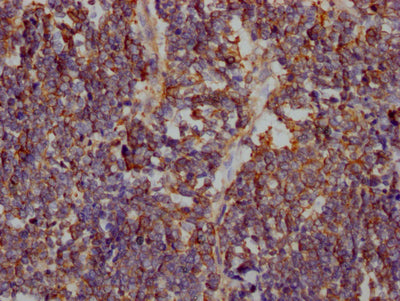 IHC image of RAC07365 diluted at 1:100 and staining in paraffin-embedded human lung cancer performed on a Leica BondTM system. After dewaxing and hydration, antigen retrieval was mediated by high pressure in a citrate buffer (pH 6.0). Section was blocked with 10% normal goat serum 30min at RT. Then primary antibody (1% BSA) was incubated at 4? overnight. The primary is detected by a Goat anti-rabbit IgG polymer labeled by HRP and visualized using 0.05% DAB.