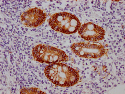 IHC image of RAC07367 diluted at 1:100 and staining in paraffin-embedded human colon cancer performed on a Leica BondTM system. After dewaxing and hydration, antigen retrieval was mediated by high pressure in a citrate buffer (pH 6.0). Section was blocked with 10% normal goat serum 30min at RT. Then primary antibody (1% BSA) was incubated at 4? overnight. The primary is detected by a Goat anti-rabbit IgG polymer labeled by HRP and visualized using 0.05% DAB.