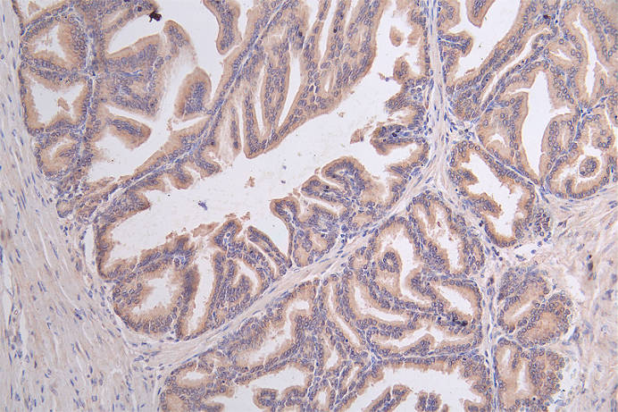 IHC image of RAC07369 diluted at 1:50 and staining in paraffin-embedded human prostate tissue performed on a Leica BondTM system. After dewaxing and hydration, antigen retrieval was mediated by high pressure in a citrate buffer (pH 6.0). Section was blocked with 10% normal goat serum 30min at RT. Then primary antibody (1% BSA) was incubated at 4Â°C overnight. The primary is detected by a Goat anti-rabbit polymer IgG labeled by HRP and visualized using 0.45% DAB.