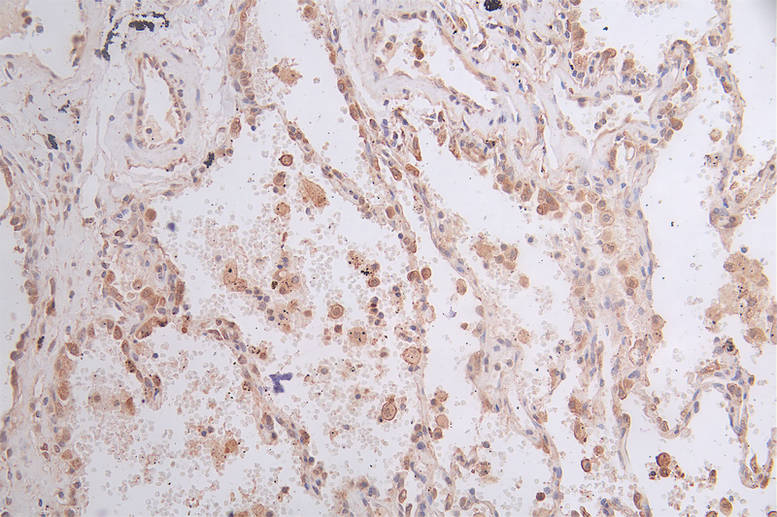 IHC image of RAC07369 diluted at 1:50 and staining in paraffin-embedded human lung cancer performed on a Leica BondTM system. After dewaxing and hydration, antigen retrieval was mediated by high pressure in a citrate buffer (pH 6.0). Section was blocked with 10% normal goat serum 30min at RT. Then primary antibody (1% BSA) was incubated at 4Â°C overnight. The primary is detected by a Goat anti-rabbit polymer IgG labeled by HRP and visualized using 0.45% DAB.