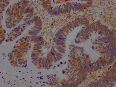 IHC image of RAC07374 diluted at 1:100 and staining in paraffin-embedded human ovarian cancer performed on a Leica BondTM system. After dewaxing and hydration, antigen retrieval was mediated by high pressure in a citrate buffer (pH 6.0). Section was blocked with 10% normal goat serum 30min at RT. Then primary antibody (1% BSA) was incubated at 4? overnight. The primary is detected by a Goat anti-rabbit IgG polymer labeled by HRP and visualized using 0.05% DAB.