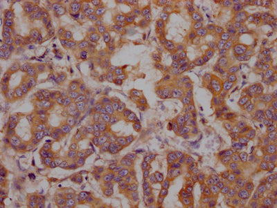 IHC image of RAC07380 diluted at 1:100 and staining in paraffin-embedded human breast cancer performed on a Leica BondTM system. After dewaxing and hydration, antigen retrieval was mediated by high pressure in a citrate buffer (pH 6.0). Section was blocked with 10% normal goat serum 30min at RT. Then primary antibody (1% BSA) was incubated at 4? overnight. The primary is detected by a Goat anti-rabbit IgG polymer labeled by HRP and visualized using 0.05% DAB.