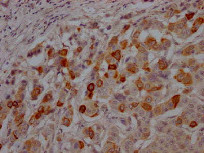 IHC image of RAC07381 diluted at 1:100 and staining in paraffin-embedded human breast cancer performed on a Leica BondTM system. After dewaxing and hydration, antigen retrieval was mediated by high pressure in a citrate buffer (pH 6.0). Section was blocked with 10% normal goat serum 30min at RT. Then primary antibody (1% BSA) was incubated at 4? overnight. The primary is detected by a Goat anti-rabbit IgG polymer labeled by HRP and visualized using 0.05% DAB.