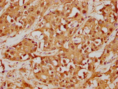 IHC image of RAC07384 diluted at 1:125 and staining in paraffin-embedded human liver cancer performed on a Leica BondTM system. After dewaxing and hydration, antigen retrieval was mediated by high pressure in a citrate buffer (pH 6.0). Section was blocked with 10% normal goat serum 30min at RT. Then primary antibody (1% BSA) was incubated at 4? overnight. The primary is detected by a biotinylated secondary antibody and visualized using an HRP conjugated SP system.