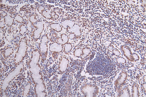 IHC image of RAC07386 diluted at 1:50 and staining in paraffin-embedded human breast cancer performed on a Leica BondTM system. After dewaxing and hydration, antigen retrieval was mediated by high pressure in a citrate buffer (pH 6.0). Section was blocked with 10% normal goat serum 30min at RT. Then primary antibody (1% BSA) was incubated at 4Â°C overnight. The primary is detected by a Goat anti-rabbit polymer IgG labeled by HRP and visualized using 0.27% DAB.