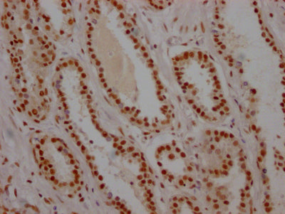 IHC image of RAC07389 diluted at 1:100 and staining in paraffin-embedded human prostate cancer performed on a Leica BondTM system. After dewaxing and hydration, antigen retrieval was mediated by high pressure in a citrate buffer (pH 6.0). Section was blocked with 10% normal goat serum 30min at RT. Then primary antibody (1% BSA) was incubated at 4? overnight. The primary is detected by a Goat anti-rabbit IgG polymer labeled by HRP and visualized using 0.05% DAB.