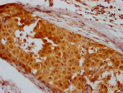 IHC image of RAC07390 diluted at 1:100 and staining in paraffin-embedded human breast cancer performed on a Leica BondTM system. After dewaxing and hydration, antigen retrieval was mediated by high pressure in a citrate buffer (pH 6.0). Section was blocked with 10% normal goat serum 30min at RT. Then primary antibody (1% BSA) was incubated at 4? overnight. The primary is detected by a Goat anti-rabbit IgG polymer labeled by HRP and visualized using 0.05% DAB.