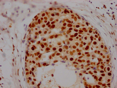 IHC image of RAC07391 diluted at 1:100 and staining in paraffin-embedded human breast cancer performed on a Leica BondTM system. After dewaxing and hydration, antigen retrieval was mediated by high pressure in a citrate buffer (pH 6.0). Section was blocked with 10% normal goat serum 30min at RT. Then primary antibody (1% BSA) was incubated at 4? overnight. The primary is detected by a Goat anti-rabbit IgG polymer labeled by HRP and visualized using 0.05% DAB.