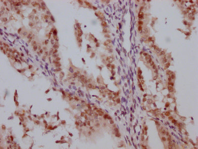 IHC image of RAC07392 diluted at 1:100 and staining in paraffin-embedded human endometrial cancer performed on a Leica BondTM system. After dewaxing and hydration, antigen retrieval was mediated by high pressure in a citrate buffer (pH 6.0). Section was blocked with 10% normal goat serum 30min at RT. Then primary antibody (1% BSA) was incubated at 4? overnight. The primary is detected by a Goat anti-rabbit IgG polymer labeled by HRP and visualized using 0.05% DAB.