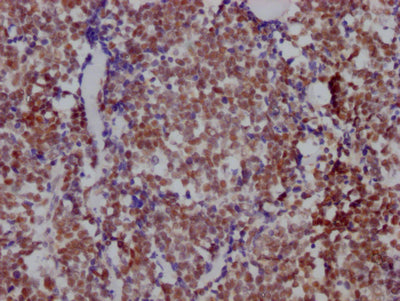 IHC image of RAC07392 diluted at 1:100 and staining in paraffin-embedded human lung cancer performed on a Leica BondTM system. After dewaxing and hydration, antigen retrieval was mediated by high pressure in a citrate buffer (pH 6.0). Section was blocked with 10% normal goat serum 30min at RT. Then primary antibody (1% BSA) was incubated at 4? overnight. The primary is detected by a Goat anti-rabbit IgG polymer labeled by HRP and visualized using 0.05% DAB.