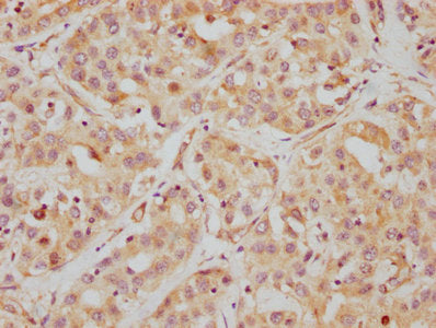 IHC image of RAC07393 diluted at 1:112.5 and staining in paraffin-embedded human liver cancer performed on a Leica BondTM system. After dewaxing and hydration, antigen retrieval was mediated by high pressure in a citrate buffer (pH 6.0). Section was blocked with 10% normal goat serum 30min at RT. Then primary antibody (1% BSA) was incubated at 4? overnight. The primary is detected by a biotinylated secondary antibody and visualized using an HRP conjugated SP system.