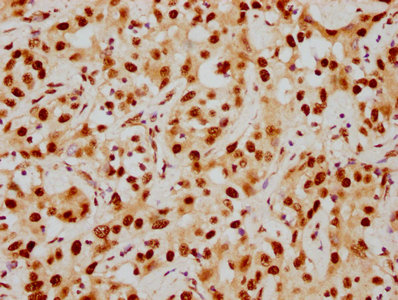 IHC image of RAC07394 diluted at 1:154 and staining in paraffin-embedded human liver cancer performed on a Leica BondTM system. After dewaxing and hydration, antigen retrieval was mediated by high pressure in a citrate buffer (pH 6.0). Section was blocked with 10% normal goat serum 30min at RT. Then primary antibody (1% BSA) was incubated at 4? overnight. The primary is detected by a biotinylated secondary antibody and visualized using an HRP conjugated SP system.