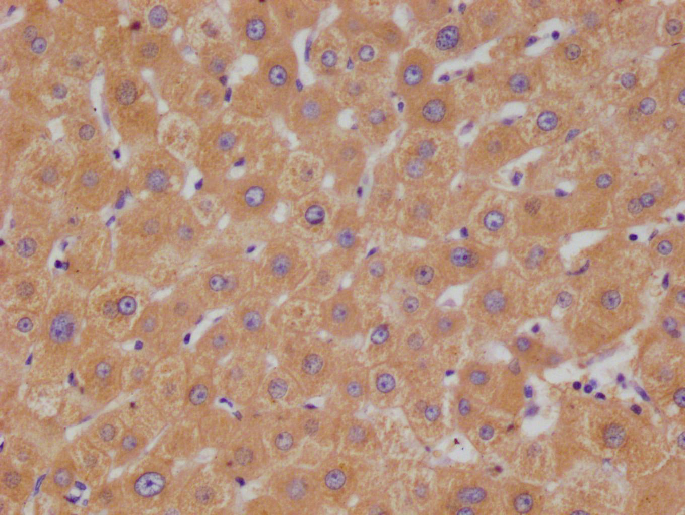 IHC image of RAC07395 diluted at 1:100 and staining in paraffin-embedded human liver cancer performed on a Leica BondTM system. After dewaxing and hydration, antigen retrieval was mediated by high pressure in a citrate buffer (pH 6.0). Section was blocked with 10% normal goat serum 30min at RT. Then primary antibody (1% BSA) was incubated at 4Â°C overnight. The primary is detected by a Goat anti-rabbit polymer IgG labeled by HRP and visualized using 0.05% DAB.