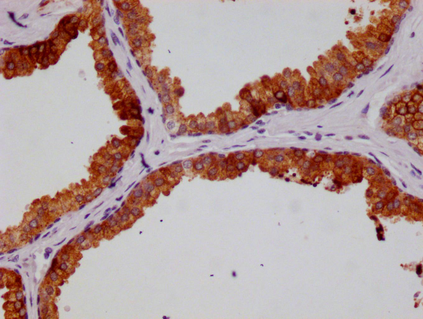 IHC image of RAC07395 diluted at 1:100 and staining in paraffin-embedded human prostate cancer performed on a Leica BondTM system. After dewaxing and hydration, antigen retrieval was mediated by high pressure in a citrate buffer (pH 6.0). Section was blocked with 10% normal goat serum 30min at RT. Then primary antibody (1% BSA) was incubated at 4Â°C overnight. The primary is detected by a Goat anti-rabbit polymer IgG labeled by HRP and visualized using 0.05% DAB.