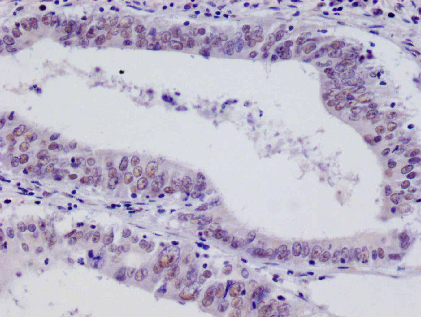 IHC image of RAC07397 diluted at 1:100 and staining in paraffin-embedded human colon cancer performed on a Leica BondTM system. After dewaxing and hydration, antigen retrieval was mediated by high pressure in a citrate buffer (pH 6.0). Section was blocked with 10% normal goat serum 30min at RT. Then primary antibody (1% BSA) was incubated at 4Â°C overnight. The primary is detected by a Goat anti-rabbit polymer IgG labeled by HRP and visualized using 0.05% DAB.