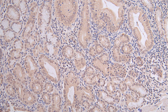 IHC image of RAC07400 diluted at 1:100 and staining in paraffin-embedded human gastric cancer performed on a Leica BondTM system. After dewaxing and hydration, antigen retrieval was mediated by high pressure in a citrate buffer (pH 6.0). Section was blocked with 10% normal goat serum 30min at RT. Then primary antibody (1% BSA) was incubated at 4Â°C overnight. The primary is detected by a Goat anti-rabbit polymer IgG labeled by HRP and visualized using 0.06% DAB.