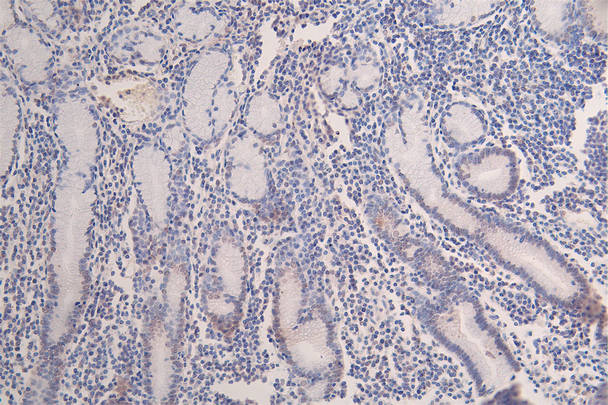 IHC image of RAC07401 diluted at 1:100 and staining in paraffin-embedded human breast cancer performed on a Leica BondTM system. After dewaxing and hydration, antigen retrieval was mediated by high pressure in a citrate buffer (pH 6.0). Section was blocked with 10% normal goat serum 30min at RT. Then primary antibody (1% BSA) was incubated at 4Â°C overnight. The primary is detected by a Goat anti-rabbit polymer IgG labeled by HRP and visualized using 0.07% DAB.